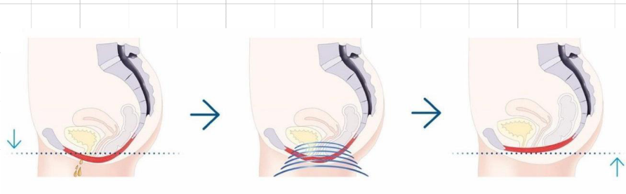 aplicatie zona intima aparat electrostimulare magnetica