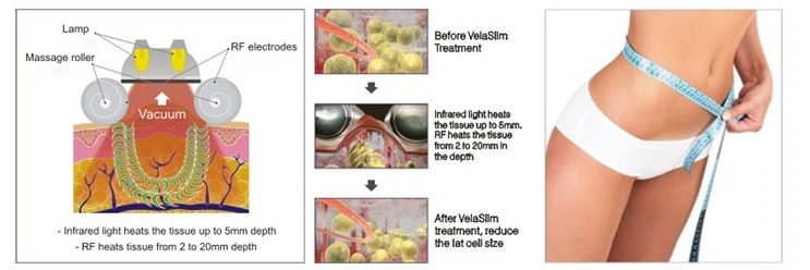 Aparat Vacuum Endermologic V-Sculptor cu Cavitatie, Radiofrecventa si Infrarosii pentru tratamente faciale si corporale